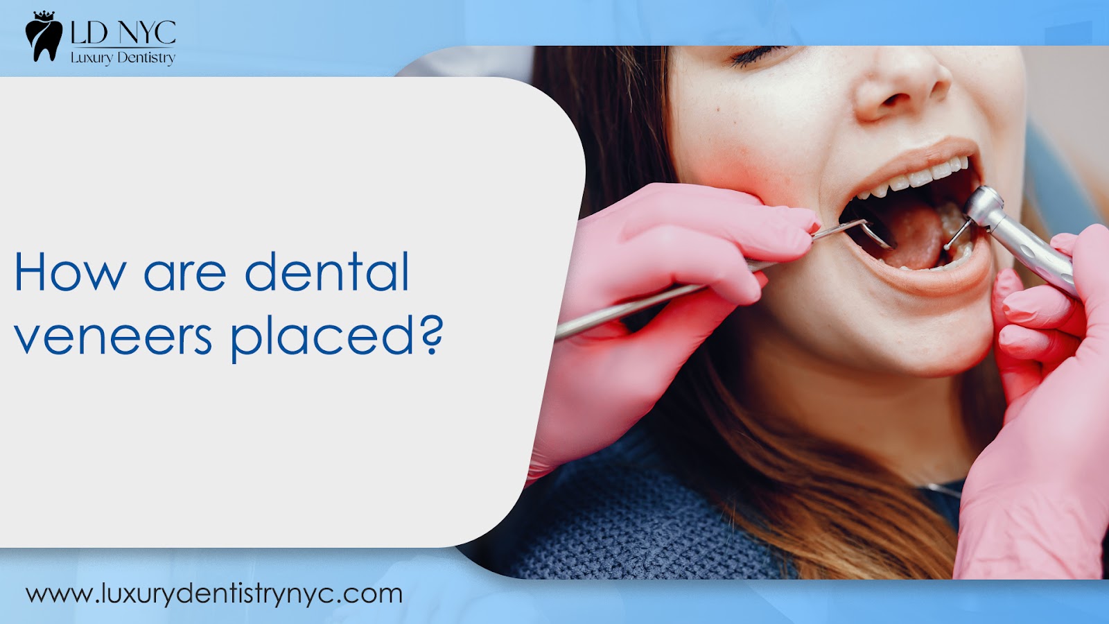 How are dental veneers placed?