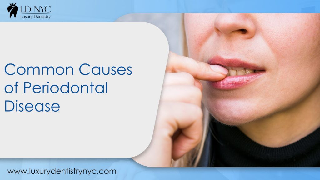 Common Causes of Periodontal Disease