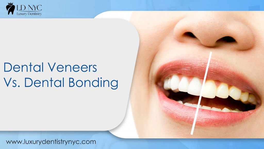 Dental Veneers Vs. Dental Bonding – Which Option is Right for Me?