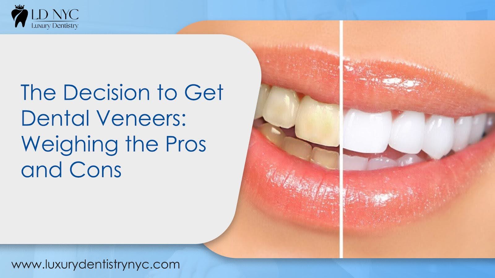 The Decision to Get Dental Veneers